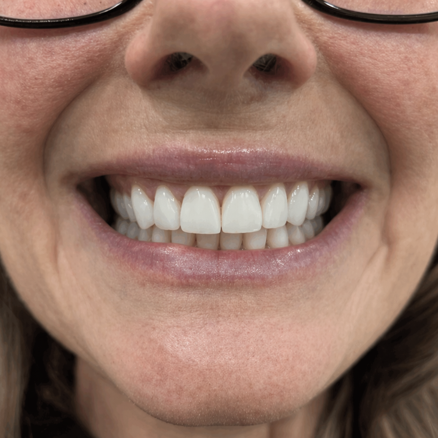 Dents visiblement plus lumineuses après l'utilisation de Velia